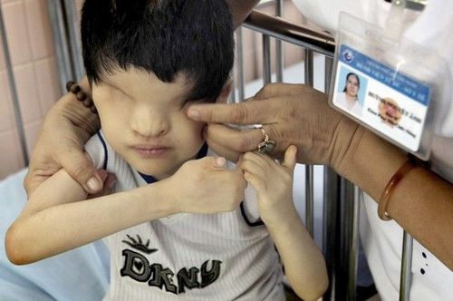 图中的这名越南儿童，一出生就没有眼睛，胡志明市的一家医院的护士正在对他进行检查，这家医院专门收治因越战期间的“橙剂”造成伤害的儿童。